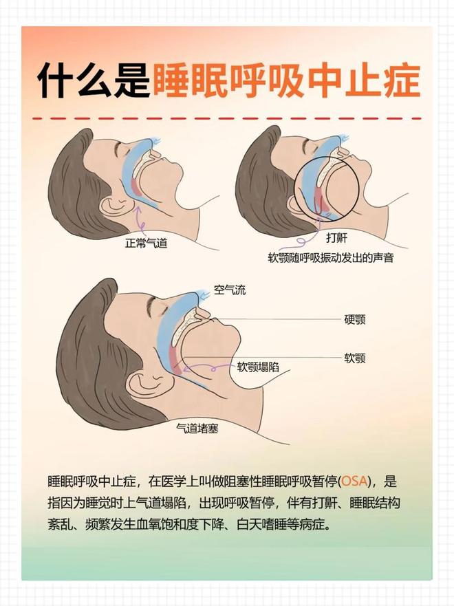 男子一年撞坏3辆豪车,怀疑自己“中邪”了,医生一查不对劲:他一晚上呼吸暂停500多次……