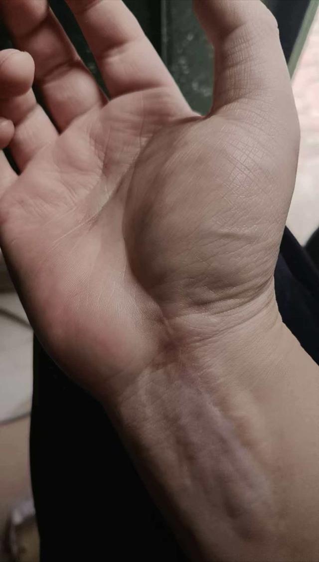 74页病历被修改30次；男子做骨折手术，陷神经损伤谜团，院前损伤还是医疗事故？