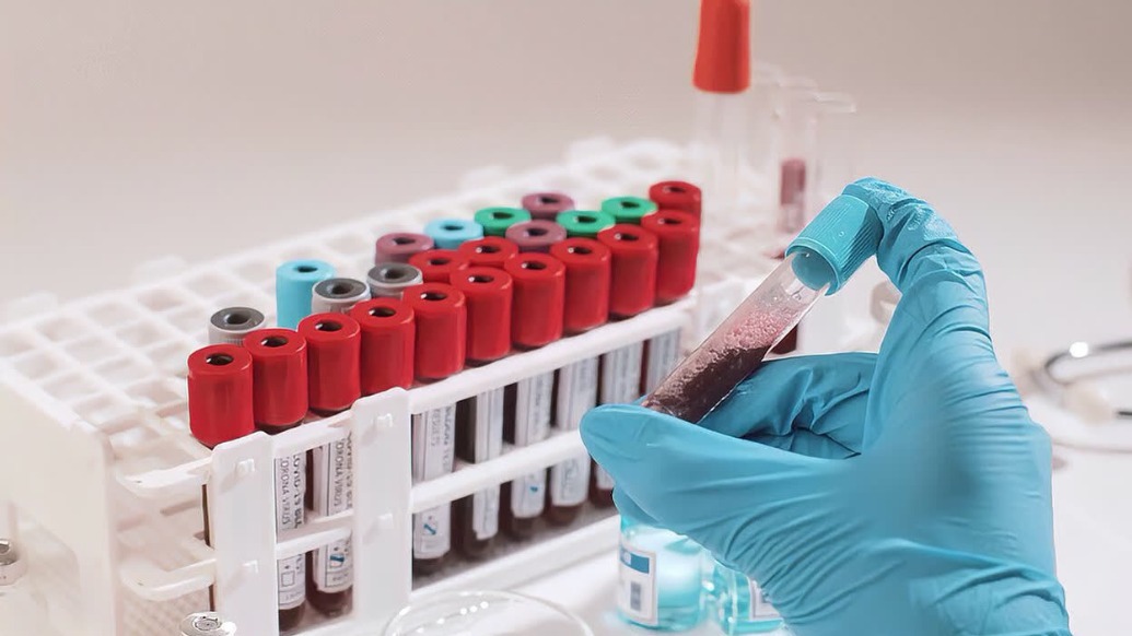 新型AI模型可通过血检识别多种神经退行性疾病