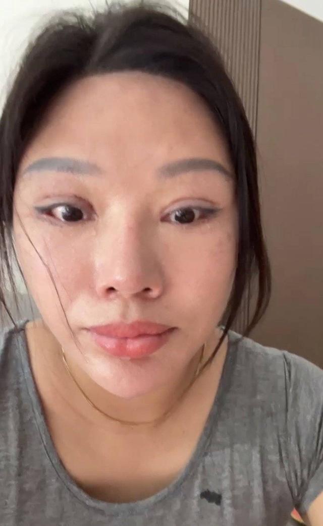 女子割双眼皮后无法闭眼 整形机构老板非法行医获刑后起诉患者“违约发布内容”